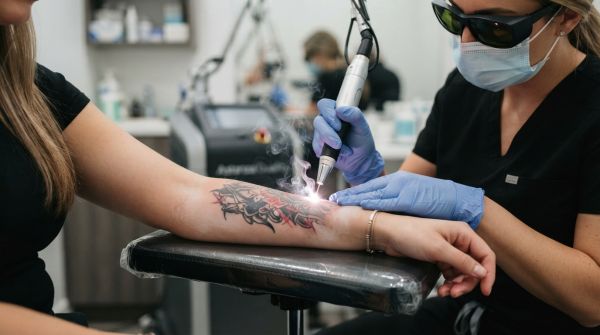 Les étapes clés du détatouage laser : guide complet sur chaque séance